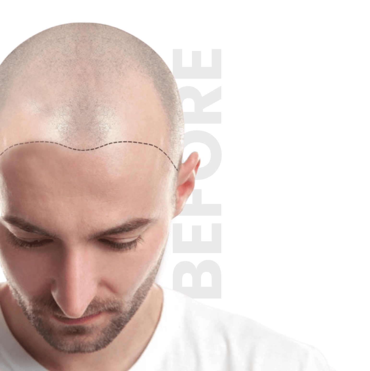 Hair Transplant New York City