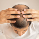 man showing his balding hair