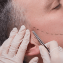 doctor marking for beard transplant
