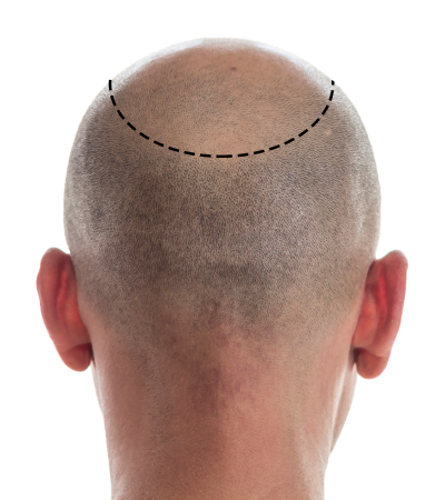 bald man crown view