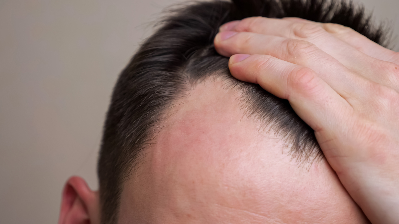 Signs Of Going Bald