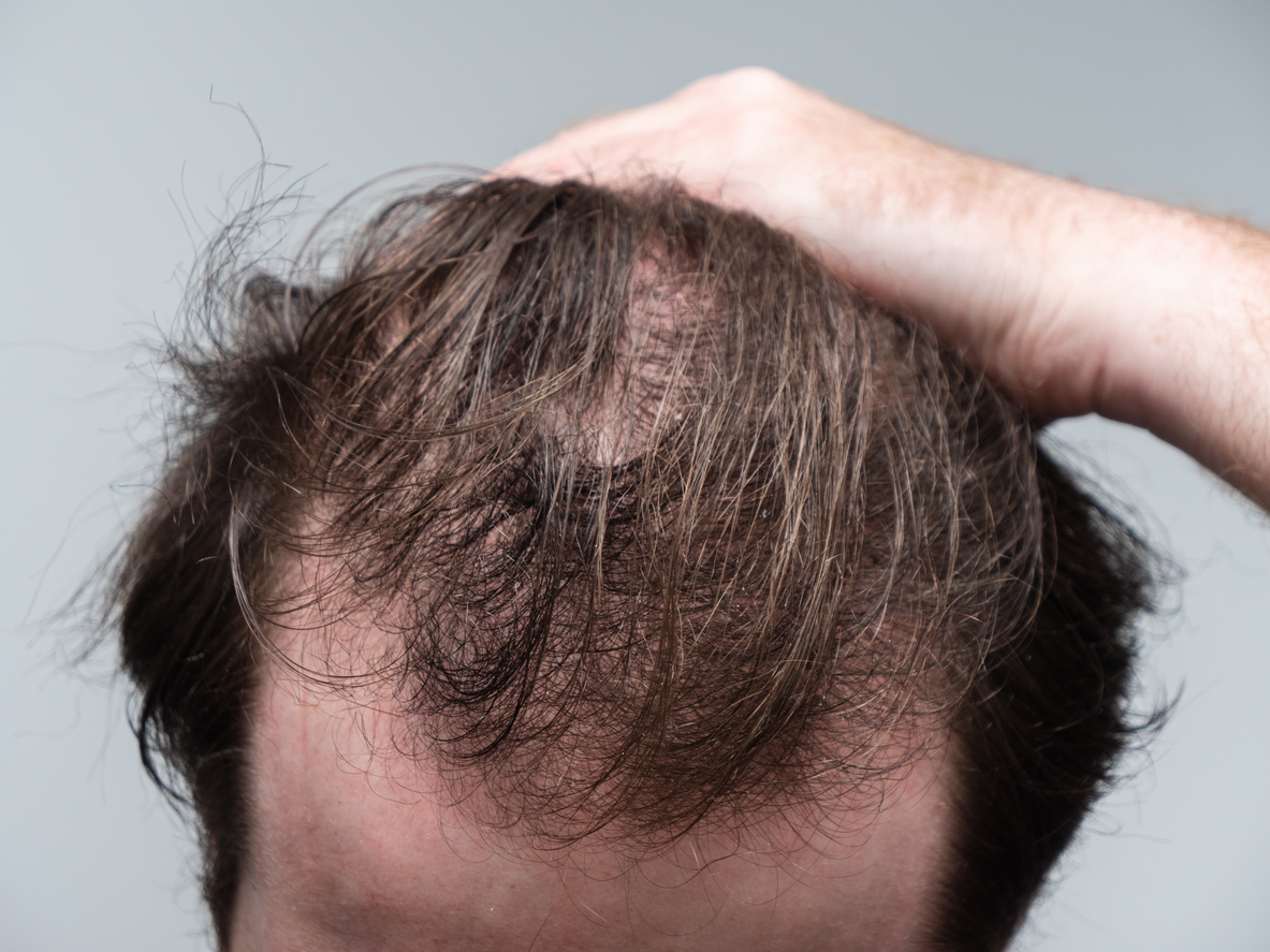 what-is-the-best-hair-loss-treatment-for-men-hair-transplant-center