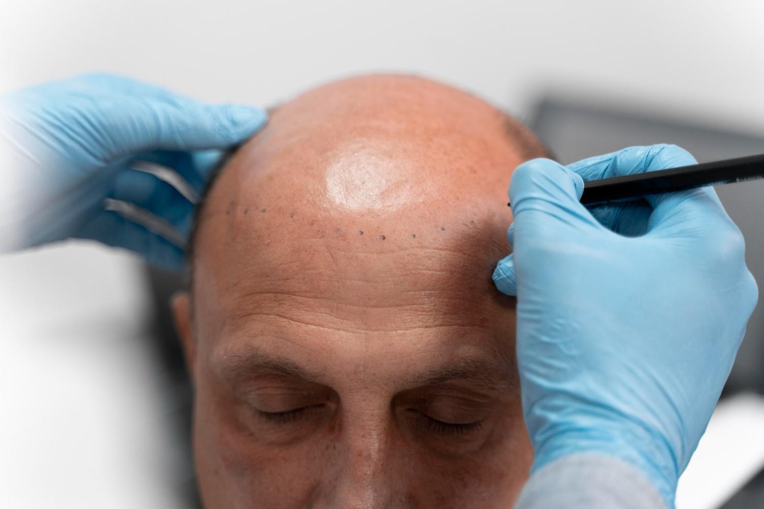 hair transplant clinic NYC selection guide